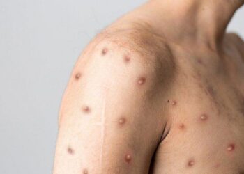 O que é mpox? Saiba como é a transmissão, os sintomas e o tratamento