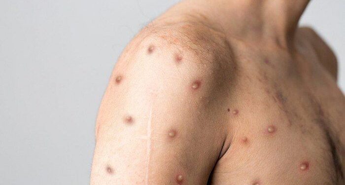 O que é mpox? Saiba como é a transmissão, os sintomas e o tratamento