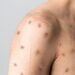 O que é mpox? Saiba como é a transmissão, os sintomas e o tratamento