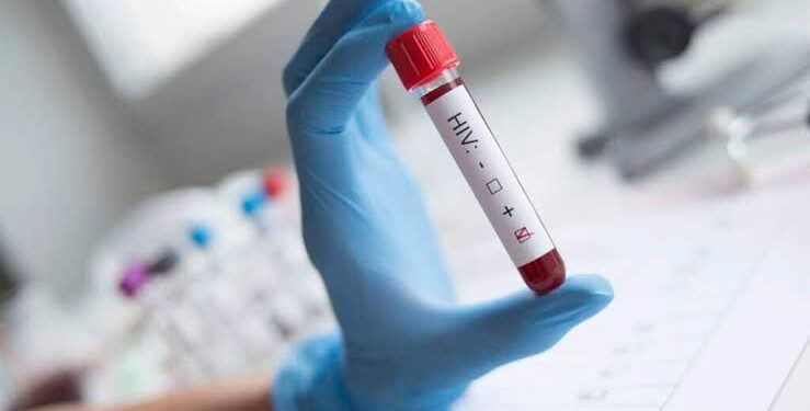 Nova variante do HIV circula em três estados do Brasil, diz estudo