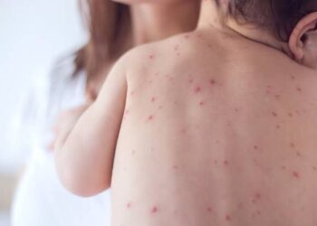 Menina de 5 anos é mais uma vítima de meningite em Alagoas; ela residia em Satuba