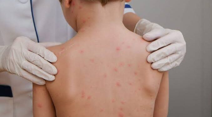 Estado de AL e municípios têm 5 dias para promover ações contra meningite