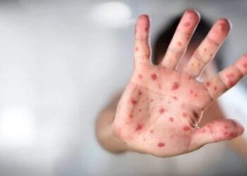 AL não tem casos de sarampo há 3 anos; Sesau alerta para vacinação