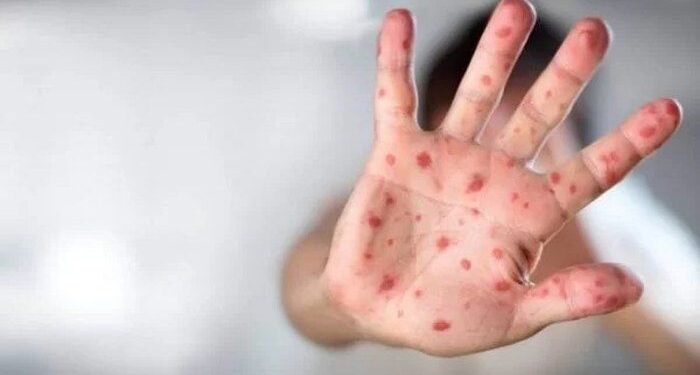 AL não tem casos de sarampo há 3 anos; Sesau alerta para vacinação