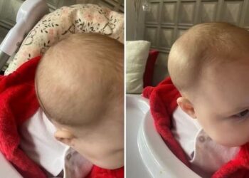 Mãe descobre fratura no crânio da filha ao buscá-la em creche